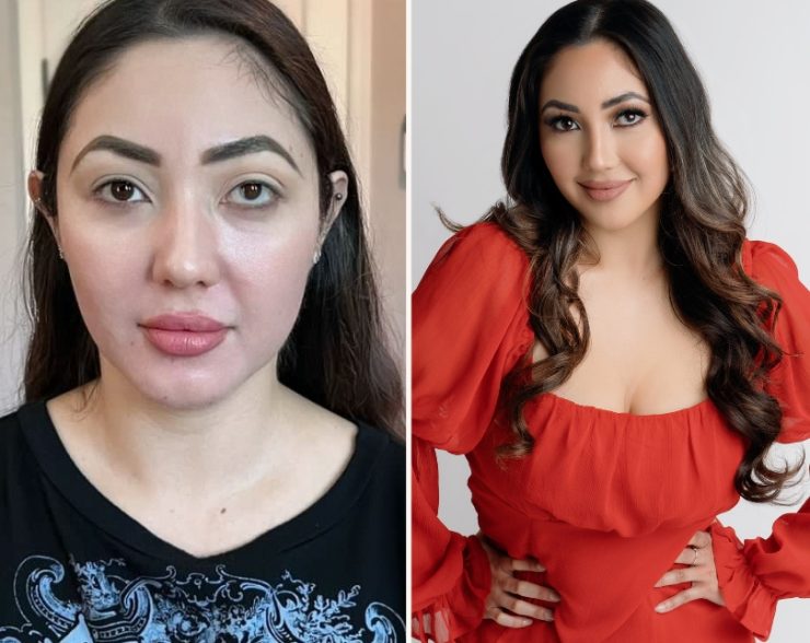 ana before after